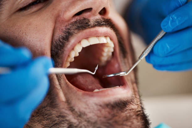 Best Emergency Tooth Extraction in Seabrook, SC